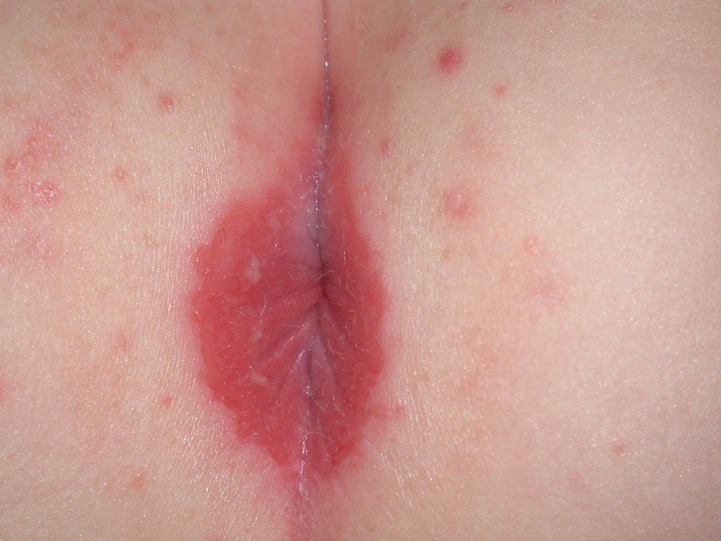 Anal rash with anus protruding
