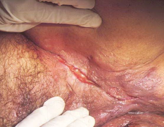 Diseases of the anus