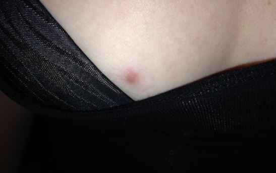 I have a zit on my boob is it normal