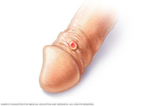 Tribune reccomend Can you get gonorrhea from a hand job