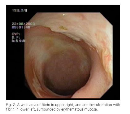Anal discharge mucus