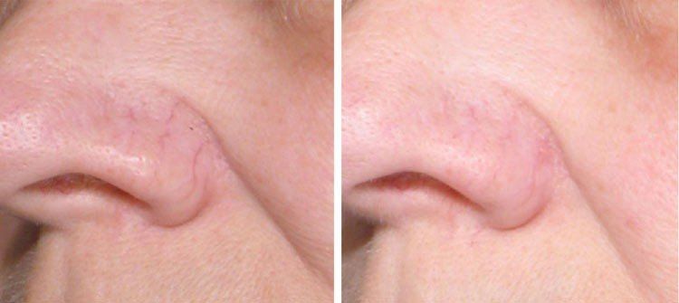 best of Pictures Facial telangiectasia