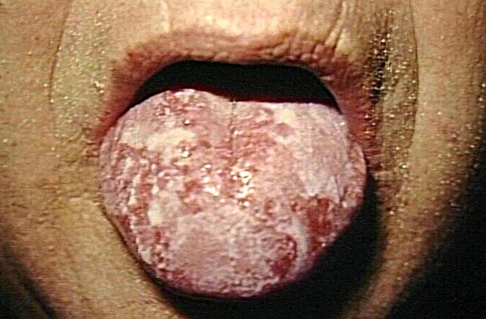 best of In mouth Gonorrhea the