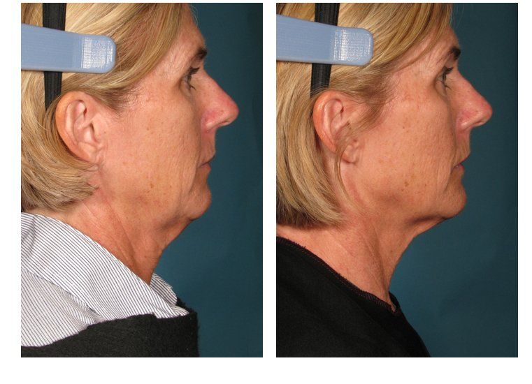 Facial skin tightening procedures hartford connecticut