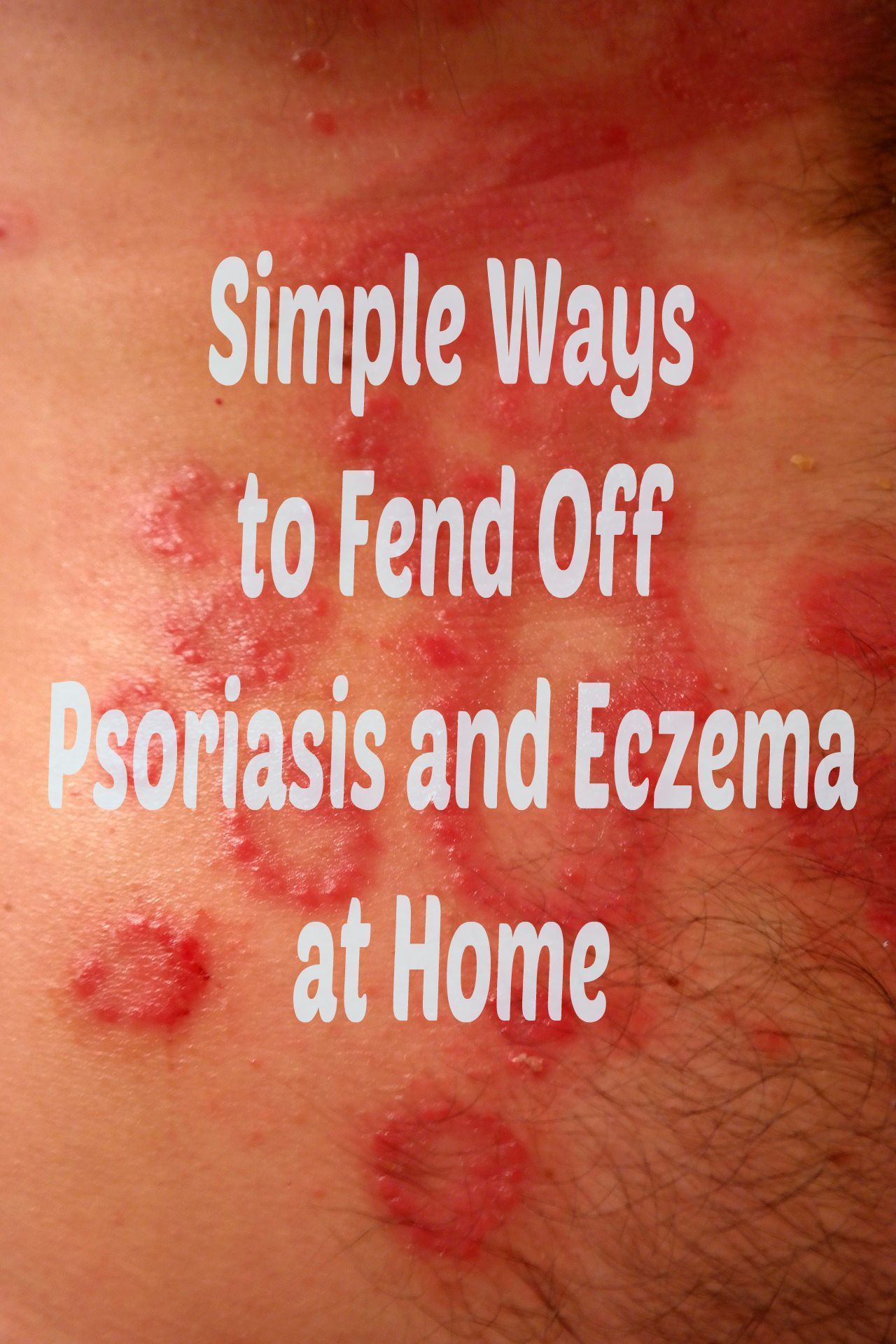 best of Facial psoriasis for Treatment