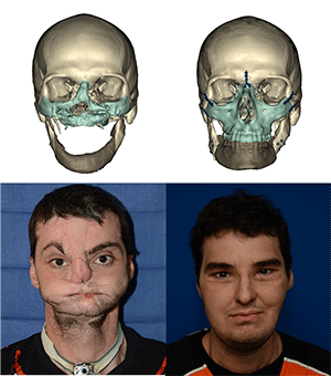 Jail B. reccomend Facial reconstruction before after photos