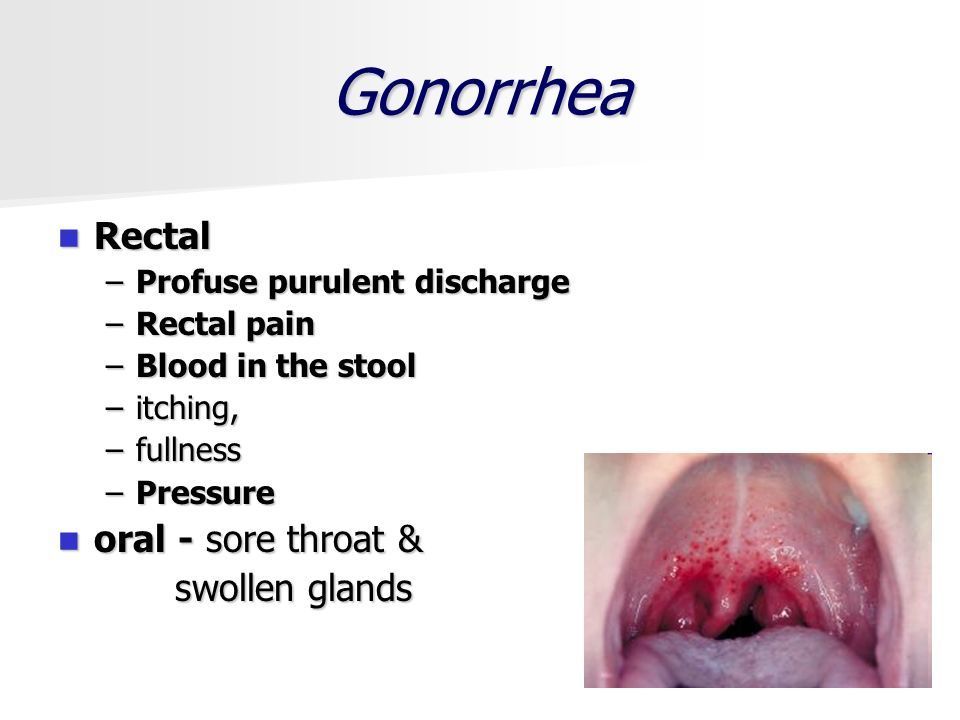 Gonorrhea in the mouth