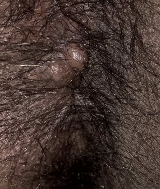 Lumps in anal area
