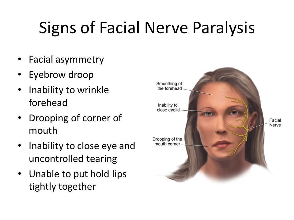 best of Facial palsy Traumatic
