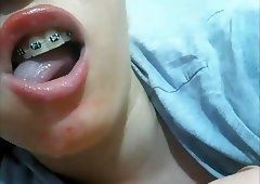 best of Fetish braces mouth